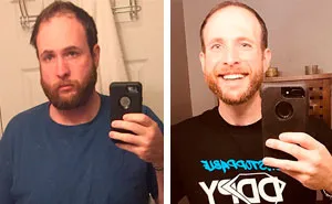 Guy Stops Drinking Alcohol, Shows How Much Sobriety Changed Him In 3 Years