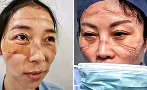 Chinese Nurses Share Pictures Of How Their Faces Look After Countless Hours Fighting The Coronavirus