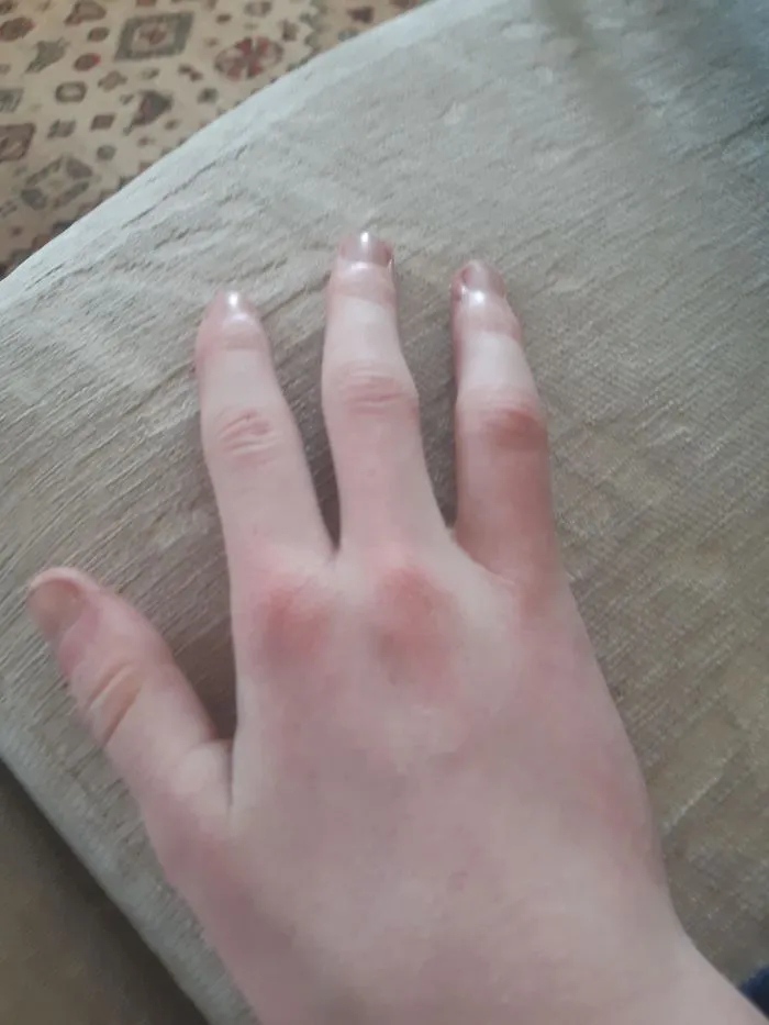 I Was Born Without A Little Finger On My Right Hand