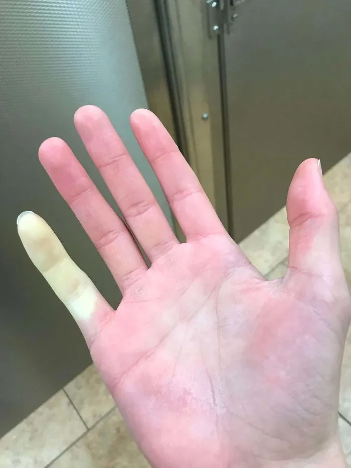 My Pinkie Was The Only Finger To Get Numb When Working Outside In The Winter
