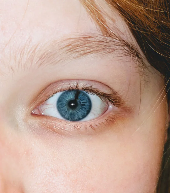 This Stripe I Have On My Left Iris