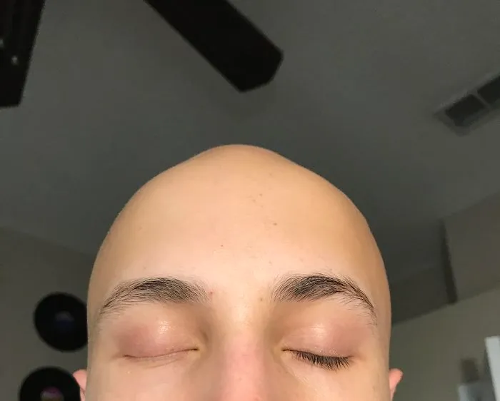 I Naturally Only Have Eyelashes On One Eye