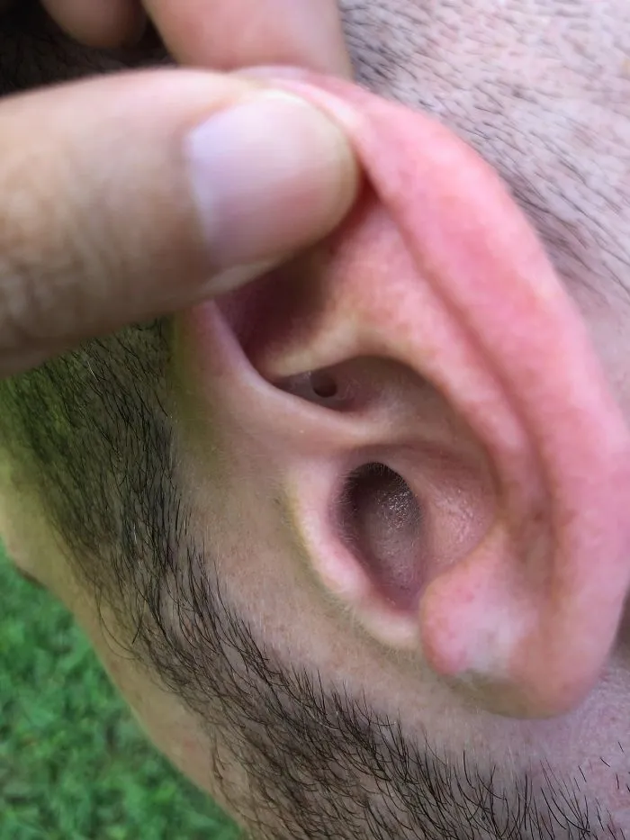 I've Known For A Few Years That I Have An Extra Hole In My Ear But Today Was The First Time I've Had Someone Take A Picture So I Could See It