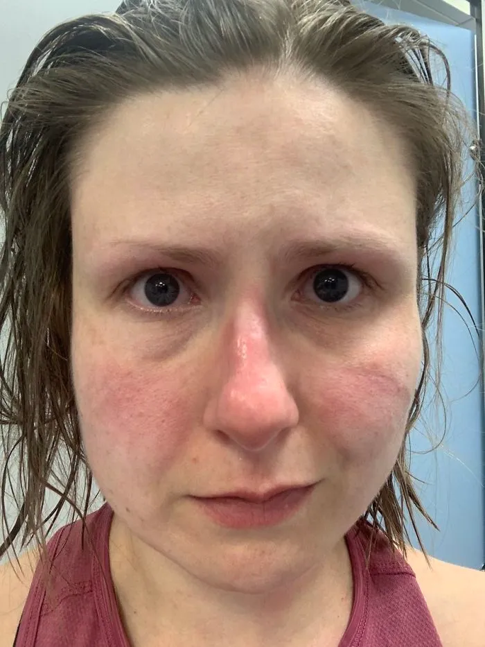 This Is The Face Of Someone Who Just Spent 9 Hours In Personal Protective Equipment Moving Critically Ill Covid19 Patients Around London