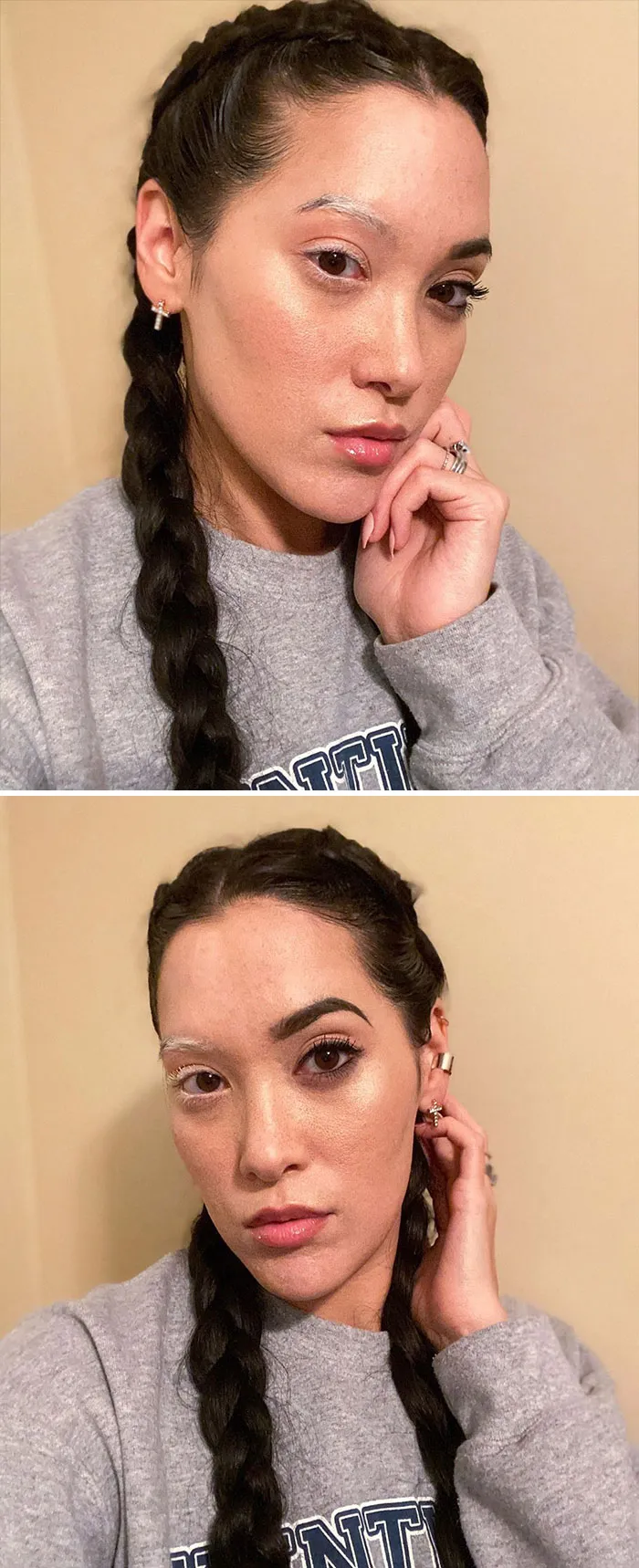 Tengo vitiligo en media cara