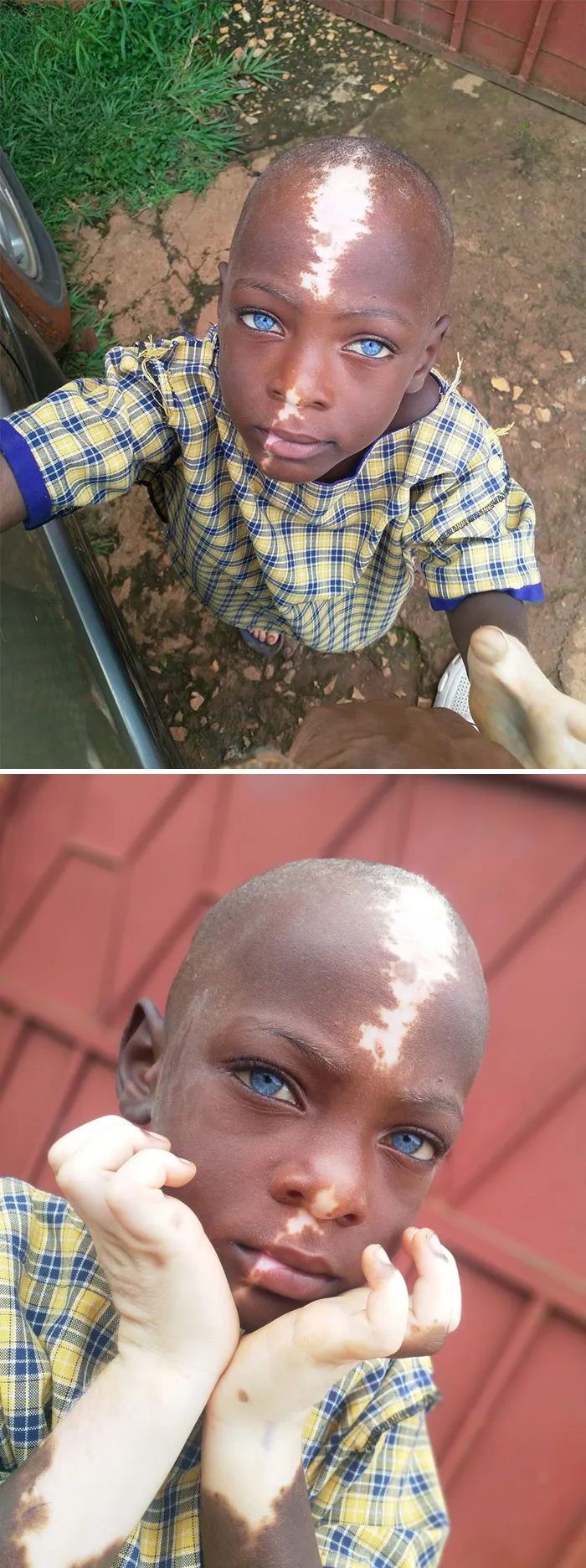 Padece del síndrome de Waardenburg