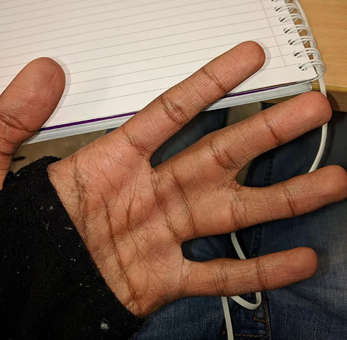 My Ring And Middle Fingers Are Connected