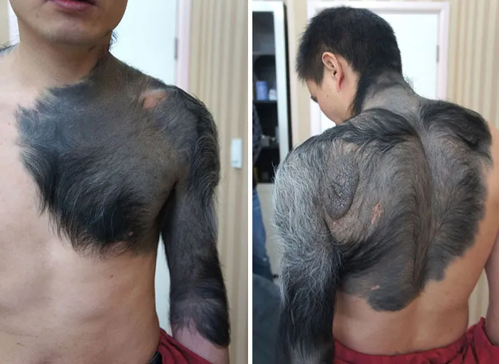Zhang Hongming sufre de nevus gigante pigmentado... lunares enormes y peludos