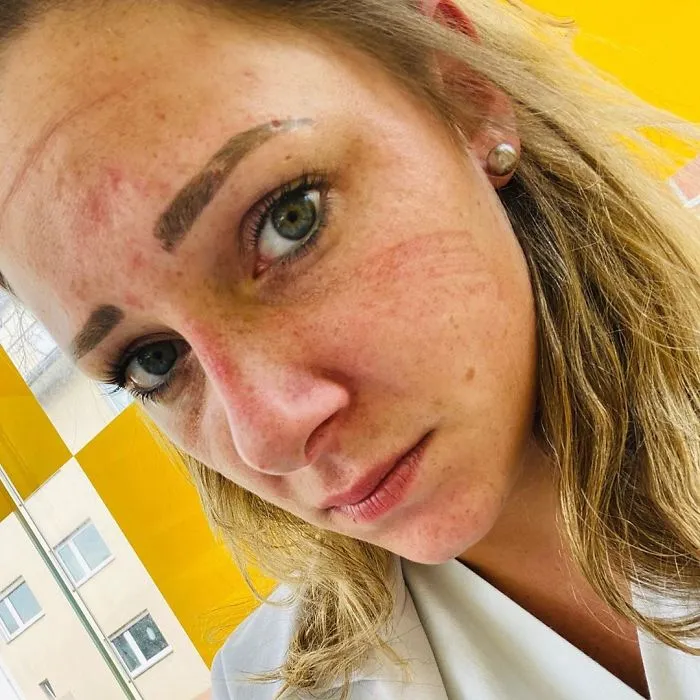 Marks On Nurse Face