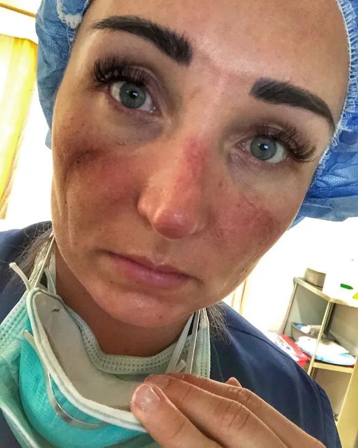 "This Is The New Normal After A Shift, Blisters On The Nose And Irritation To My Face"