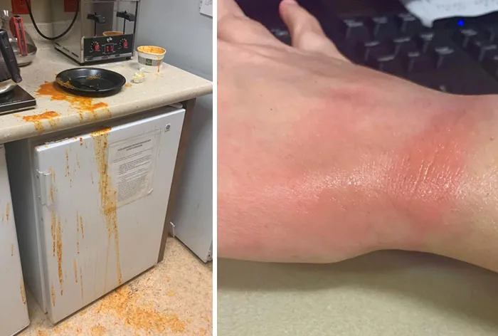 Me he abrasado la mano sacando sopa de tomate del microondas