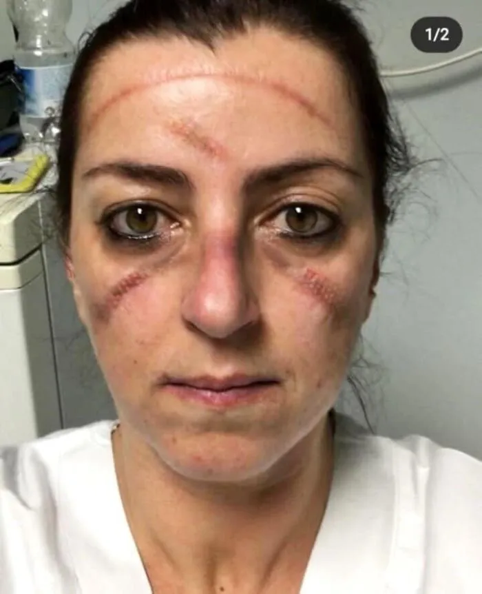 An Unnamed, Unidentified Medical Professional Is Seen With Dark Bruises Covering Her Face