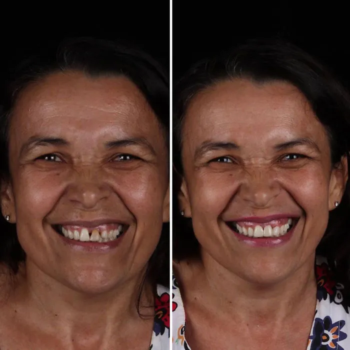 Brazilian Dentist Travels To Fix The Teeth Of Less-Fortunate People For Free And Here Are 30 New Transformations