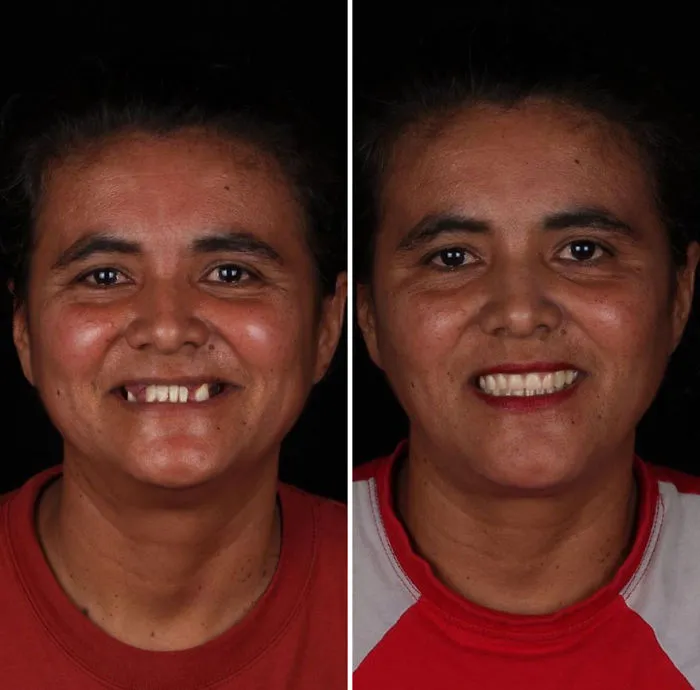 Brazilian Dentist Travels To Fix The Teeth Of Less-Fortunate People For Free And Here Are 30 New Transformations
