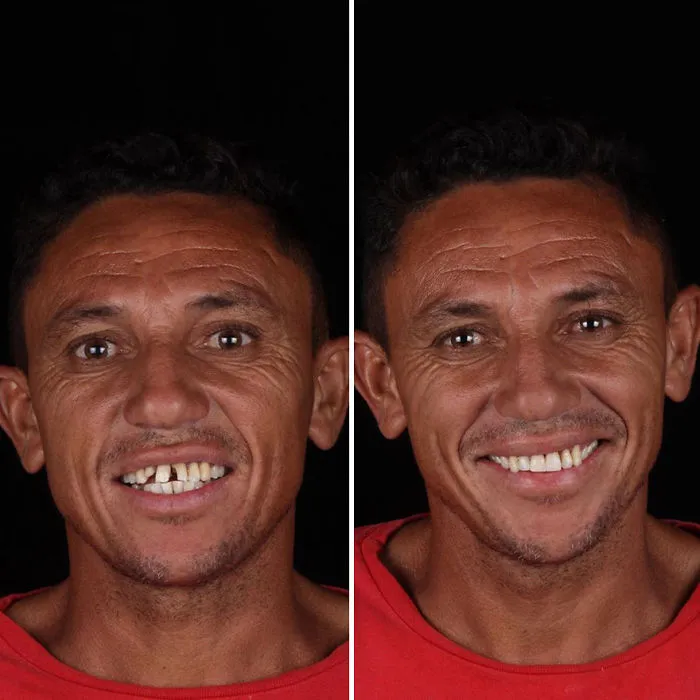 Brazilian Dentist Travels To Fix The Teeth Of Less-Fortunate People For Free And Here Are 30 New Transformations