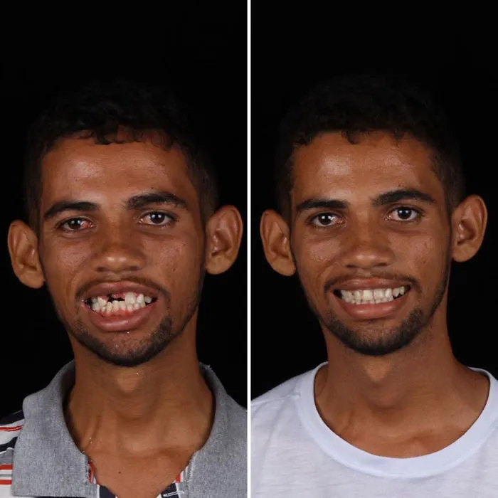Brazilian Dentist Travels To Fix The Teeth Of Less-Fortunate People For Free And Here Are 30 New Transformations
