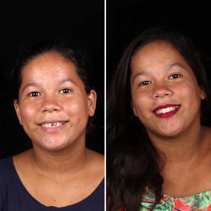 Brazilian Dentist Travels To Fix The Teeth Of Less-Fortunate People For Free And Here Are 30 New Transformations