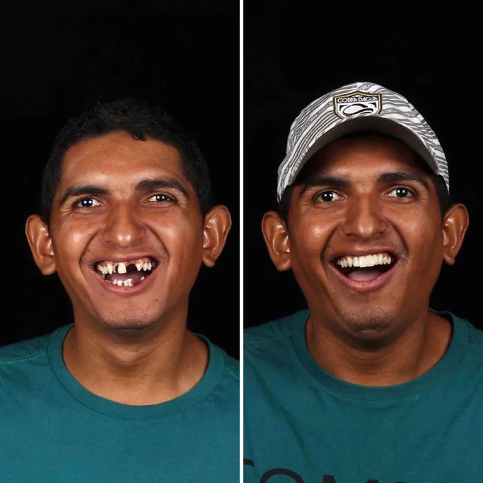 Brazilian Dentist Travels To Fix The Teeth Of Less-Fortunate People For Free And Here Are 30 New Transformations