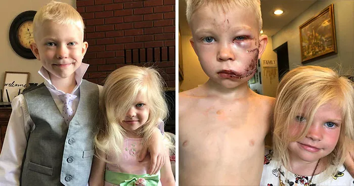 6-Year-Old Superhero Saves Sister From Dog Attack, Gets 90 Stitches And Praise From The Avengers