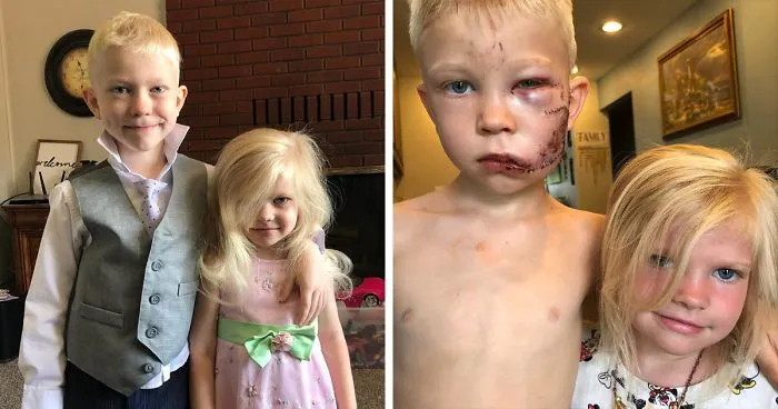 Este héroe de 6 años salva a su hermana del ataque de un perro, recibe 90 puntos de sutura y alabanzas de los Vengadores