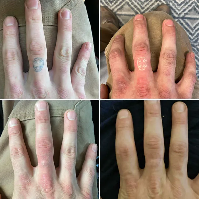 Two-Hour Time Progression Of Getting My Hate Tattoo Removed Today