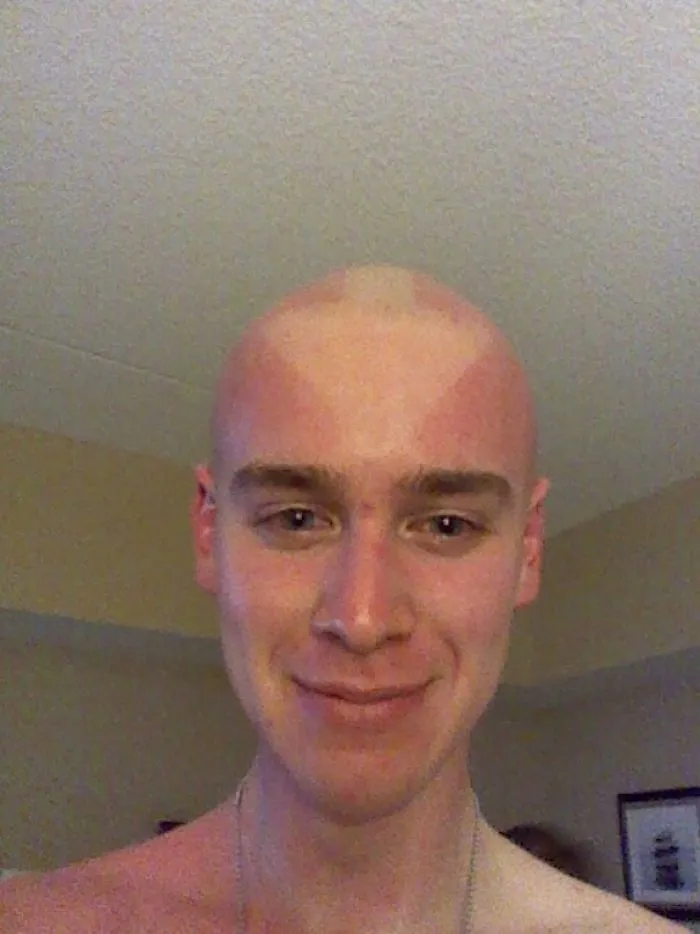 Sunburn