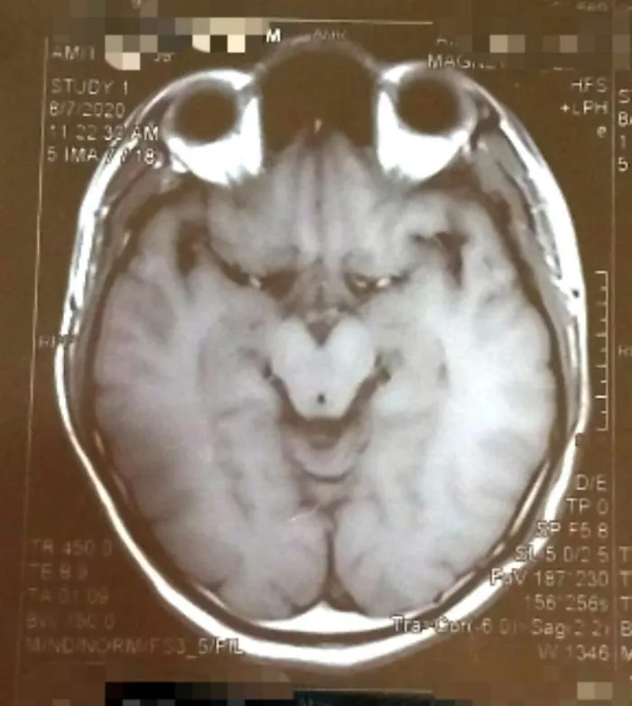 My Brain MRI Looks Like The Grinch