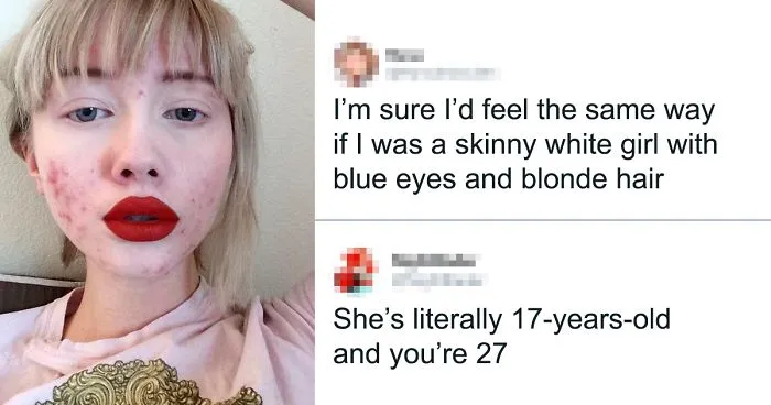 'I'm Sure I'd Feel The Same Way If I Was A Skinny White Girl': Person Attacks A Girl With Acne, Gets Put In Their Place Immediately