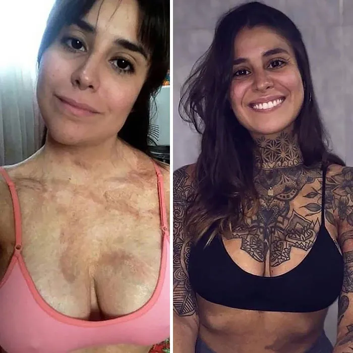 De adolescente sufrió un accidenté que le quemó el pecho, el cuello y los brazos. 10 años después se ha curado de forma inimaginable