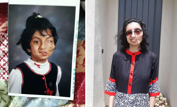 Yo en el colegio antes de operarme VS yo en 2020