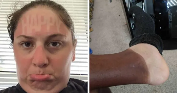 "Always Wear Sunscreen!": 40 People Who Failed To Do It And Ended Up Looking Like Dorks