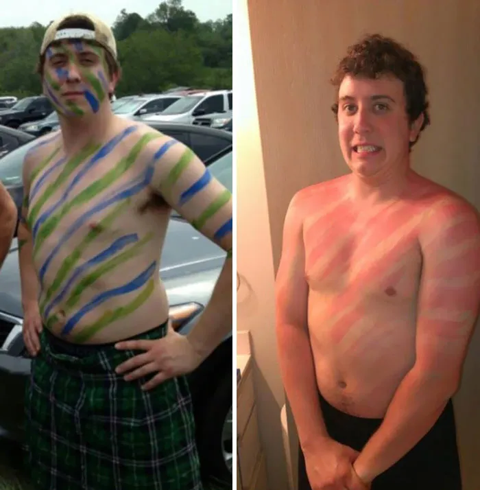 Someone Forgot His Sunscreen