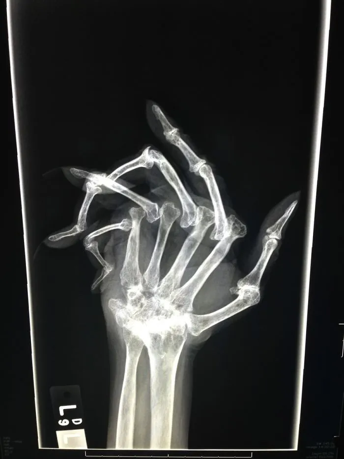 Advanced Rheumatoid Arthritis