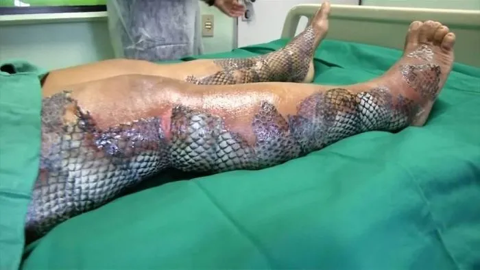 Cierta piel de pescado puede injertarse en quemaduras y heridas diabéticas. El material recluta las células propias del cuerpo y se convierte finalmente en tejido vivo