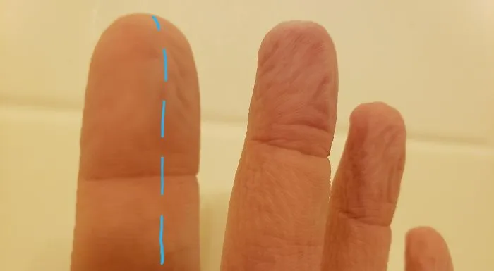 What Happens If You Spend A Lot Of Time In The Water And Your Index Finger Has A Severed Nerve