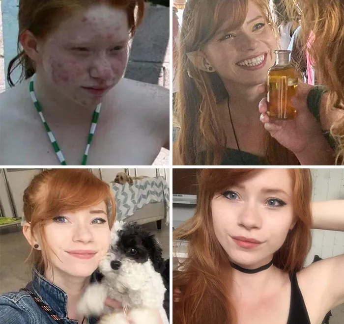 Cuando tenía unos 11 años y ahora con 25. Mi piel se "limpió", me puse ortodoncia, aprendí a maquillarme y a hacerme las cejas. Se burlaban de mi en mi infancia y creo que tuvo impacto en como soy ahora. Sed amables.