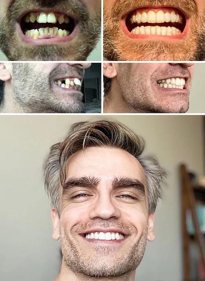 After A Lifetime Of Having Bad Teeth, I Decided To Do Something About It. A Year In Comparison