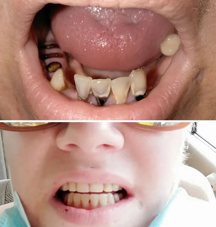 Kind Strangers Randomly Volunteered To Pay For Extensive Dental Work I Needed Done For 2 Years. Today I Was Able To Get It Done