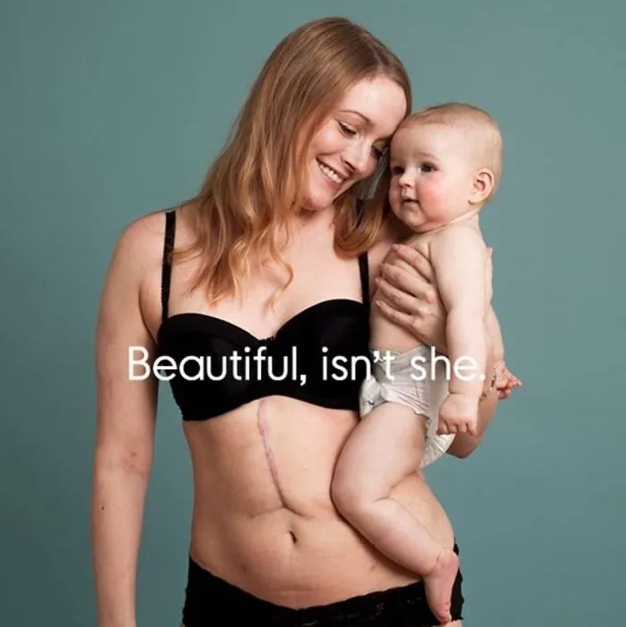 Louise, 29 Weeks After Giving Birth