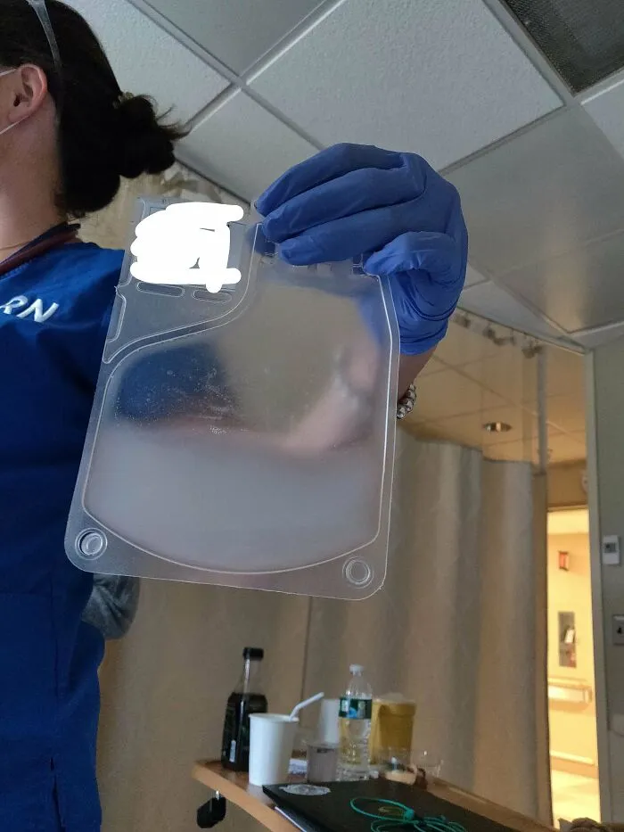 Here Are My Removed & Genetically Modified White Blood Cells, About To Be Put Back In To Hopefully Cure My Cancer! This Is T-Cell Immunotherapy!