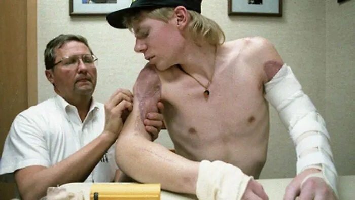 John Thompson Was Home Alone When He Had Both His Arms Ripped Off In A Farming Accident. However, He Still Managed To Get Up And Dial For Help Via Holding A Pencil In His Mouth. He Survived And Both His Arms Were Reattached