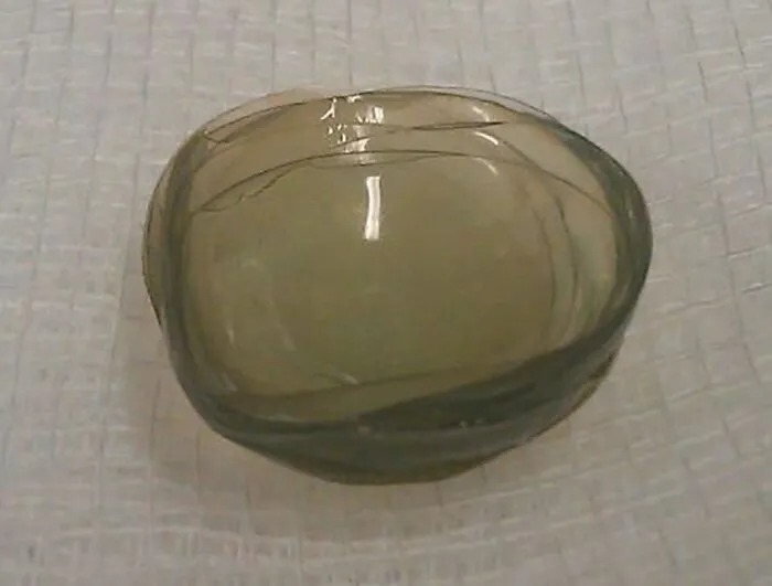 27 lentillas encontradas en el ojo de un paciente