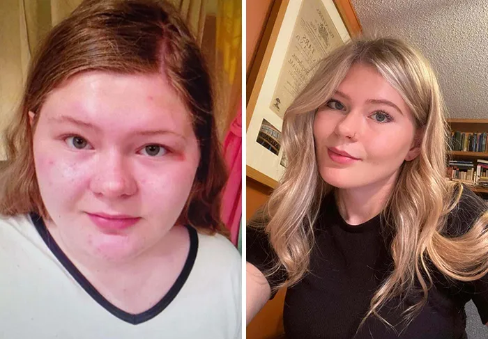 De 15 A 19 Me Gustaría Dar Las Gracias A Accutane  Y A Perder 40 Kilos