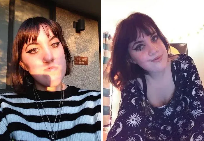 [16-17] Dos Selfies, Antes Y Después De La Doble Cirugía De Mandíbula