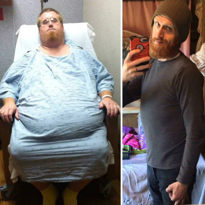 150lbs Weight Loss Progress