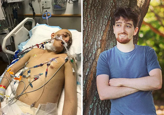 Hace 2 años recibí un transplante de médula ósea para curarme de mi 2ª recaida de leucemia. Hoy estoy oficialmente curado