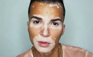 After Battling Depression For A Decade, This Brazilian Model With Vitiligo Learnt To Accept Himself