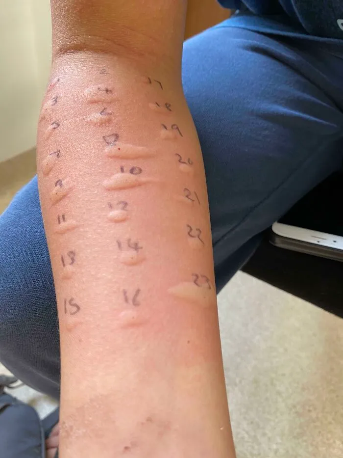Mi hijo de 12 años, prácticamente alérgico a todo