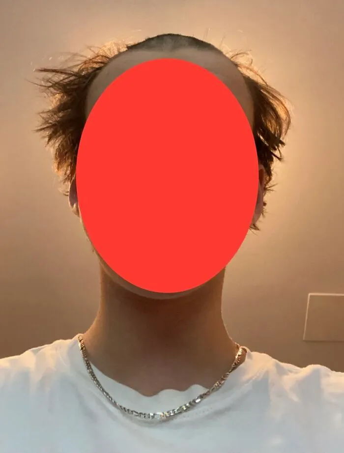Tried To Buzzcut My Hair Because All The Barbers Were Closed, Clipper Called It Quits Halfway Through. 4 Days Until My Amazon One Arrives