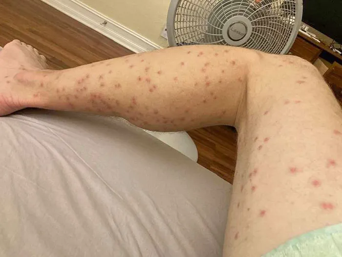 Acampar y establecer un nuevo récord de picaduras de insectos